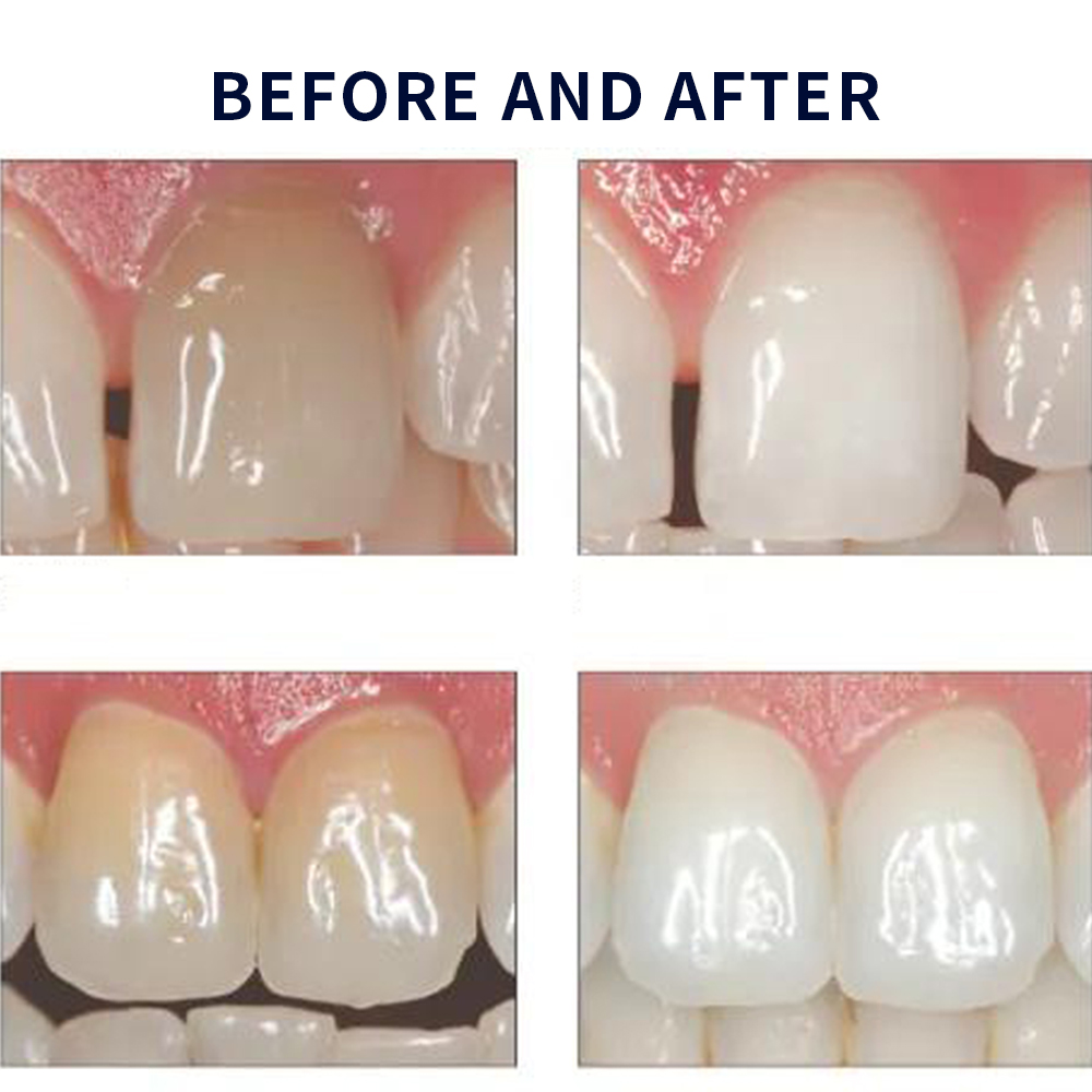 Opalescence Whitening 20% PF 2 - Teeth Whitening At Home Kit recensione e prezzo