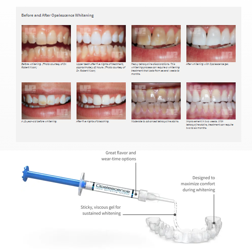 Opalescence Whitening 20% PF 2 - Teeth Whitening At Home Kit recensione e prezzo
