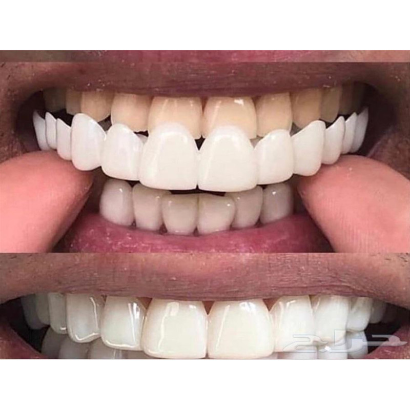 Faccette Dentali Speciali per  - Teeth Whitening For Photos recensione e prezzo