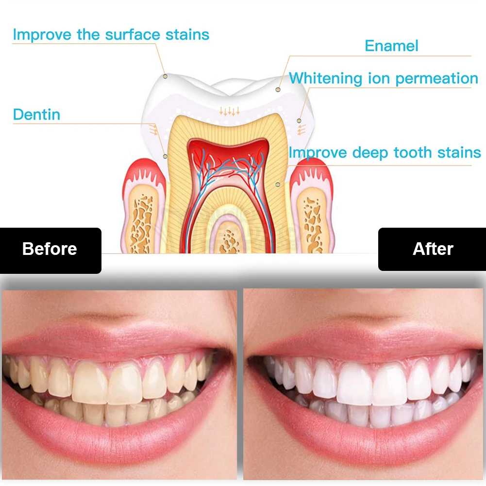 Kit per sbiancamento dei denti - Teeth Whitening Pen recensione e prezzo